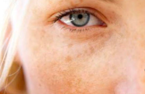 Hyper-pigmentation Correction Peels Class