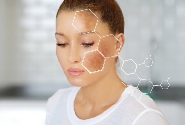 Hyperpigmentation Peels