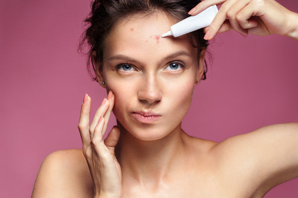 Acne Class from Face to Back-  Holistic concepts included
