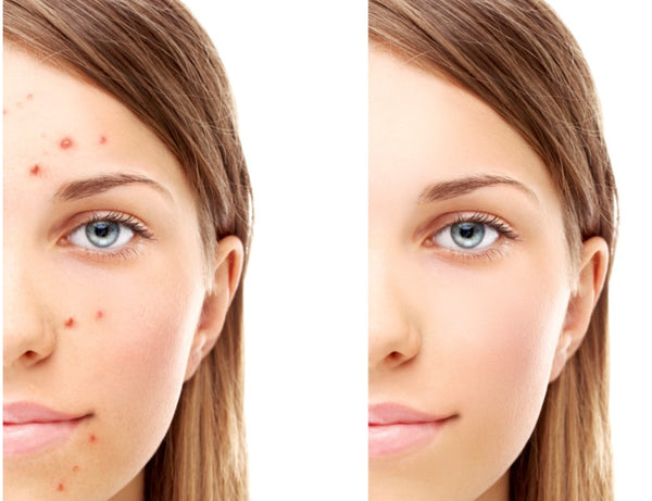 Acne Solutions